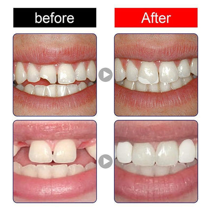 Temporary Tooth Repair Kit Resin Fix Broken False Teeth Fill Gaps Dental Denture - Aimall