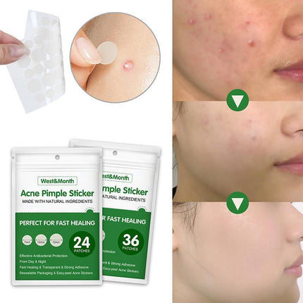 Skin Tag Remover Acne Pimple Patch Removal Facial Care Spot Plaster - Aimall