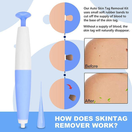 Auto Skin Tag Remover Bands Tool Loader Natural Spot Removal Cleaning Swabs Kit - Aimall