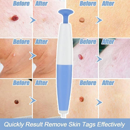 Auto Skin Tag Remover Bands Tool Loader Natural Spot Removal Cleaning Swabs Kit - Aimall
