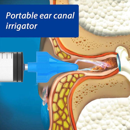Ear Cleaning Irrigation Kit Ear Wax Removal Tool Water Washing Syringe - Aimall