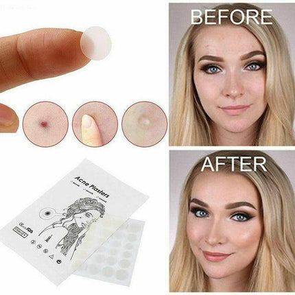36 Pcs Acne Pimple Plasters Patch Removal Blemish Control Skin Facial Care Spot - Aimall
