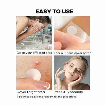 36 Pcs Acne Pimple Plasters Patch Removal Blemish Control Skin Facial Care Spot - Aimall