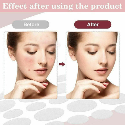 36 Pcs Acne Pimple Plasters Patch Removal Blemish Control Skin Facial Care Spot - Aimall