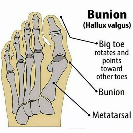 Bunion Corrector Hammer Toe Splint Straightener Orthopedic Brace Hallux Valgus - Aimall